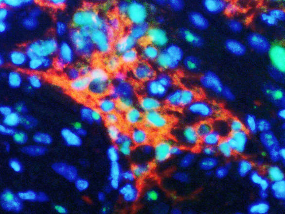 Cellule staminali tumorali (in rosso) sostenute dalla proteina Id-2 (in turchese) - Ph. Columbia University, New York
