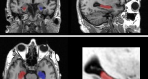 Squadra di fisici baresi vince ad Harvard prestigiosa competizione internazionale sulla diagnosi radiologica delle malattie neurovegetative